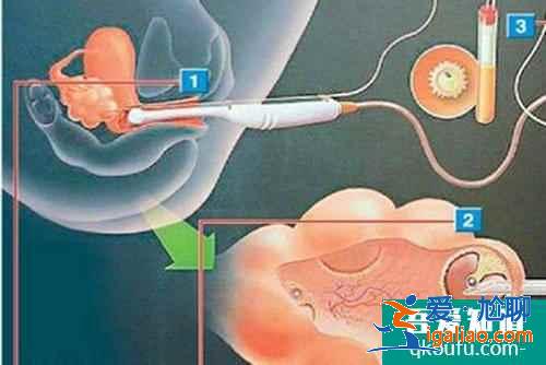 試管嬰兒懷多胎后為什么需要減胎?？