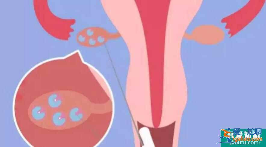 腹部取卵手術是什么？？