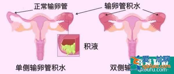 輸卵管積水的女性赴美做試管嬰兒，有什么樣的方案？？