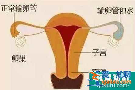 輸卵管積水還能做試管嬰兒嗎？是否會對試管成功率有影響？？