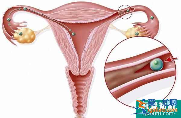 女性宮腔積水做試管嬰兒的成功率有多高？？