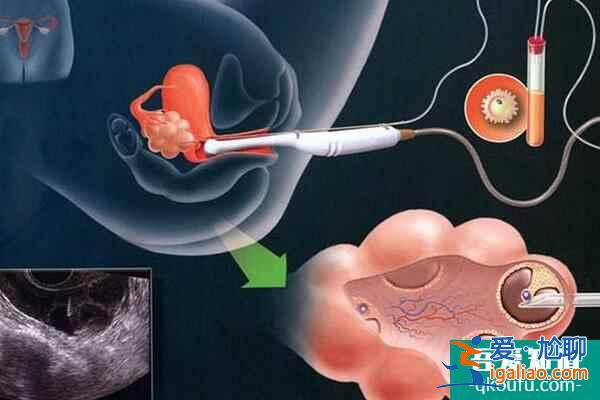女性卵巢早衰，是先調(diào)理還是可以直接做泰國(guó)試管嬰兒？？