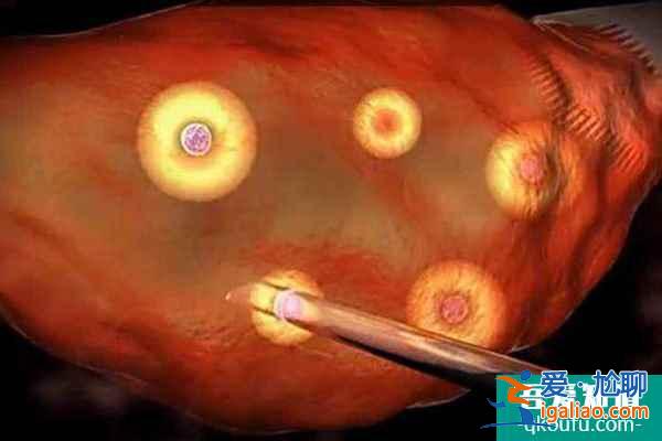 去泰國做試管嬰兒使用的促排藥安全嗎？？