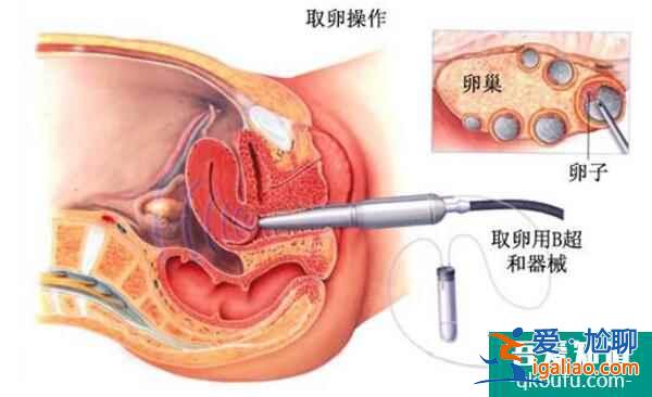 了解自然絕經與人工絕經，泰國試管嬰兒的促排/取卵方案？