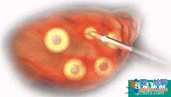 試管嬰兒專家:避免不正規的IVF周期,才能保障成功率? 試管嬰兒專家:避免不正規的IVF周期,才能保障成功率?