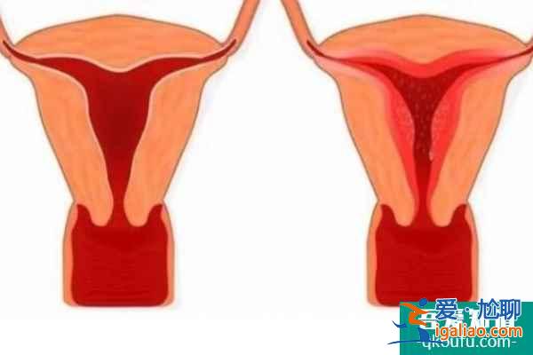 子宮內(nèi)膜薄由什么因素所致,試管嬰兒如何提高成功率?? 子宮內(nèi)膜薄由什么因素所致,試管嬰兒如何提高成功率??