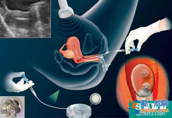第三代試管嬰兒可以保證安全嗎？？