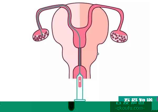 高齡女性去做試管嬰兒，IVF專家從五個方面著手提高取卵數量？