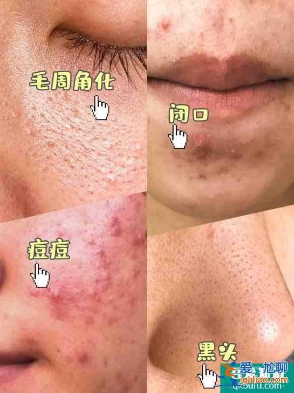 女明星的護(hù)膚方法解決了我的痘痘痘印問題！？