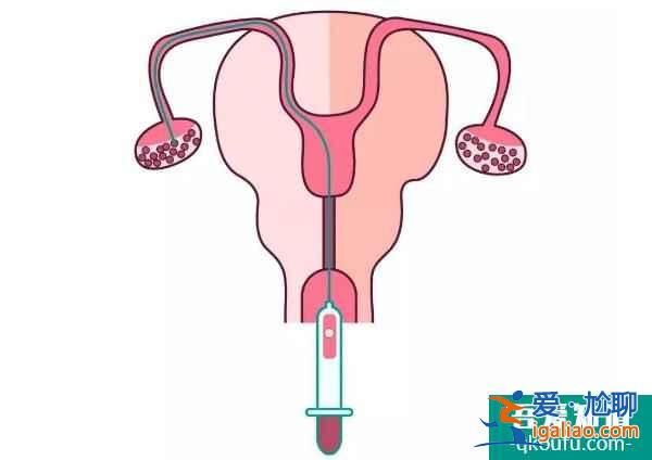 試管嬰兒促排與乳腺癌之間是否有關系?？