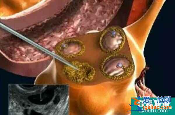 試管嬰兒:FSH值過(guò)高就說(shuō)明卵泡質(zhì)量差?? 試管嬰兒:FSH值過(guò)高就說(shuō)明卵泡質(zhì)量差??