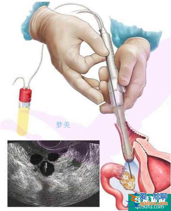 試管專家深度解析：黃體不足對胚胎著床的影響？