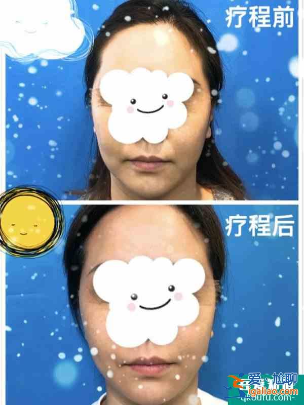明星最愛打的水光針 到底靠不靠譜？？