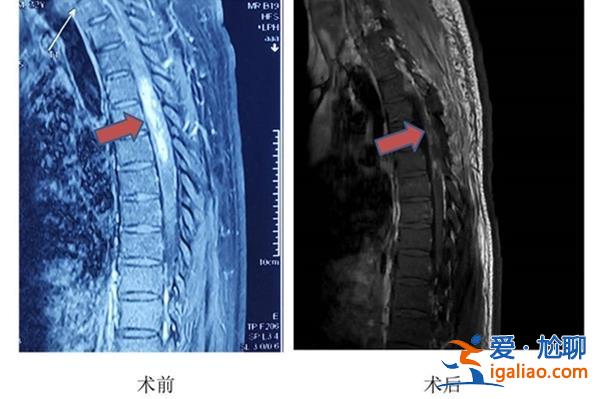 湖北男子胸口喘不過氣，醫生發現是脊髓里長了腫瘤[喘不過氣]？