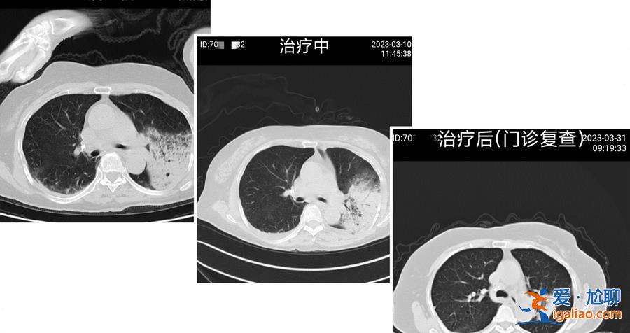 上海77歲阿婆感染“鸚鵡熱”呼吸衰竭 多家醫(yī)院收到類似病例？