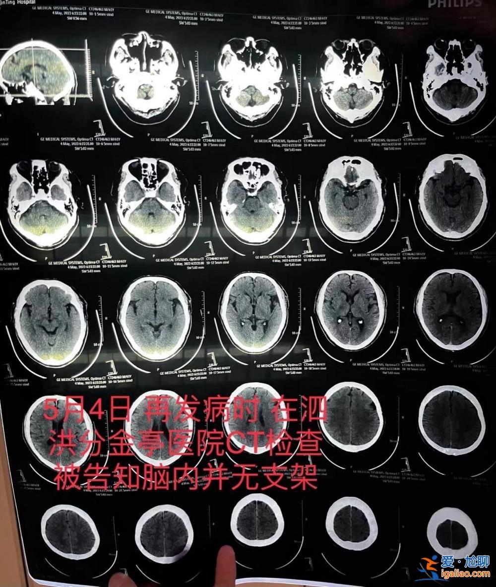江蘇一患者因腦梗去世 醫生承認此前未成功植入腦血管支架并隱瞞？