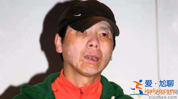 馮小剛白癜風病怎么治好的?本人稱沒吃任何藥 馮小剛白癜風病怎么治好的?本人稱沒吃任何藥