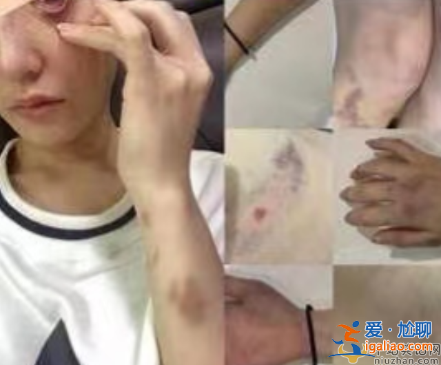 網紅蔡瑛紋被男友家暴致流產，控訴男方吃軟飯還劈腿