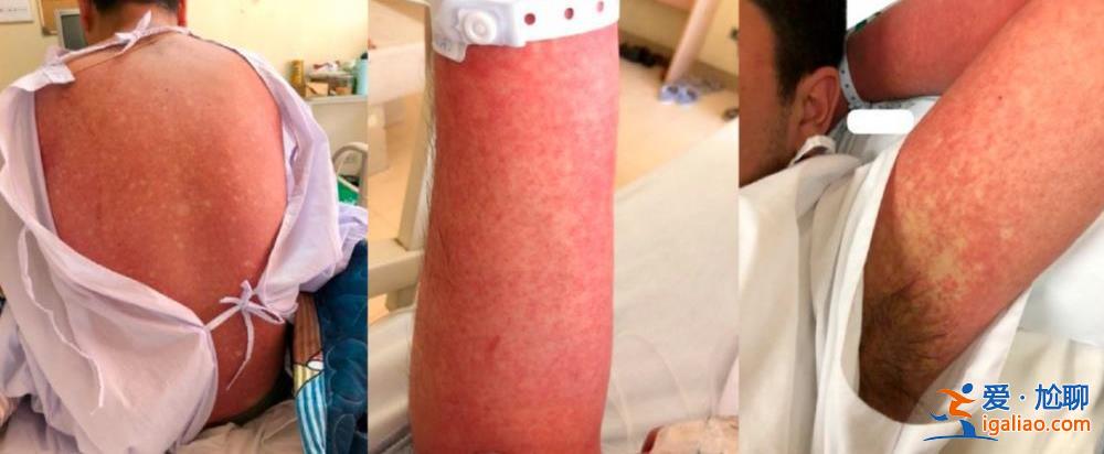 廣東茂名出現2例輸入性登革熱病例？