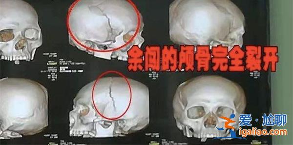 被打破頭骨女生已清醒，家屬回應(yīng)頭骨打碎看這一點(diǎn)[家屬回應(yīng)頭骨打碎看這一點(diǎn)]？
