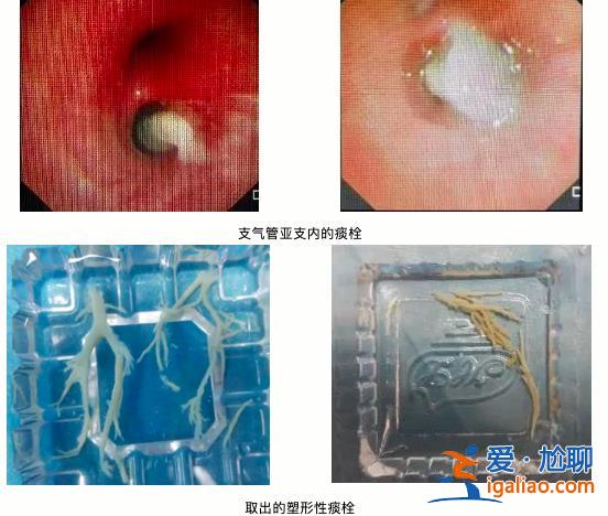 7歲男童肺部實變 有醫院一天最高峰67例“洗肺”？