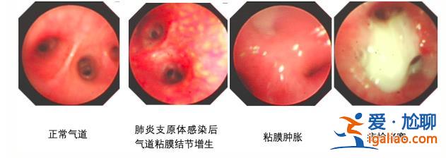 7歲男童肺部實變 有醫院一天最高峰67例“洗肺”？