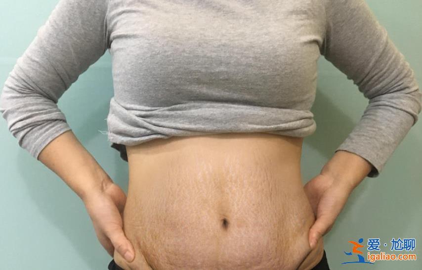 27歲寶媽與自己的妊娠紋和解了，母愛太偉大了[祛除妊娠紋]？
